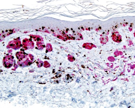 posterbrain - Water - MM_arising_in_nevus_KiMart_CP5289_10__1a.jpg