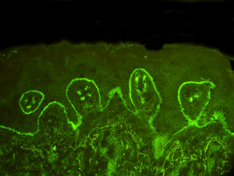 posterbrain -  - Carrick_854_C3_b_linear_IgA_vancomycin_e.jpg