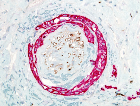 posterbrain - Blue - S100_pancytokeratin_2.jpg